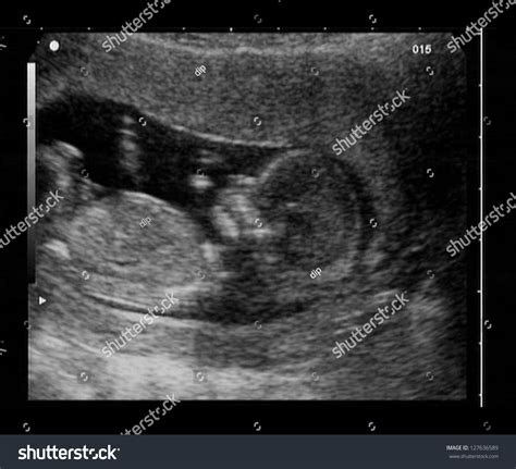 Ultrasound Fetus 12 Weeks Stock Photo 127636589 | Shutterstock