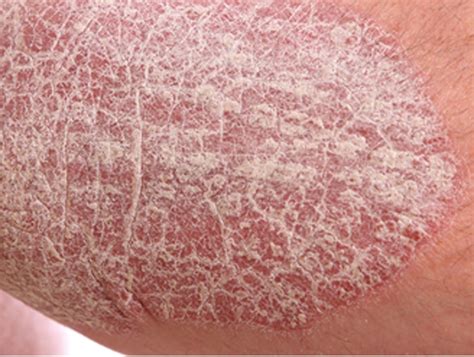 Pin on Psoriasis