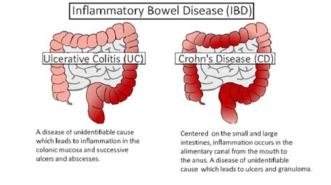 Inflammatory Bowel Disease Ibd Symptoms And Management Helal Medical