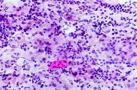 Paps Smear Microscopic Examination Of Pap Smear Showing Inflammatory Smear With Early Atrophic