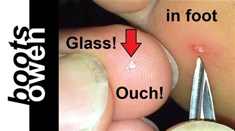 How To Remove A Tiny Shard Of Glass Embedded In Foot Try This One Simple Easy Trick Youtube