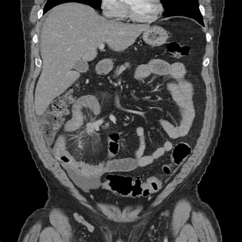 Carcinoid Tumor In Mesentery With Desmoplastic Reaction Body Mr Case