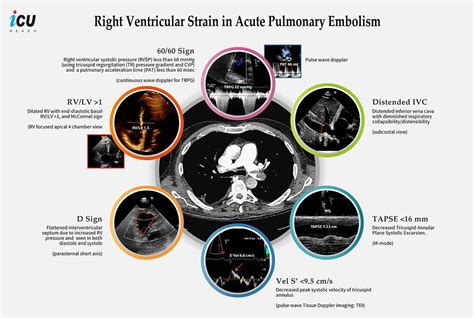 Echocardiographic Signs Of Right Ventricular Strain In Acute Pulmonary Embolism