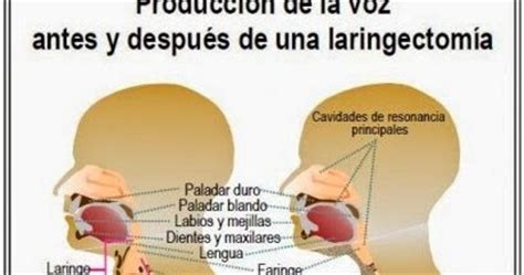 Asociaci N Barcelonesa De Laringectomizados Por Qu Y C Mo Pueden