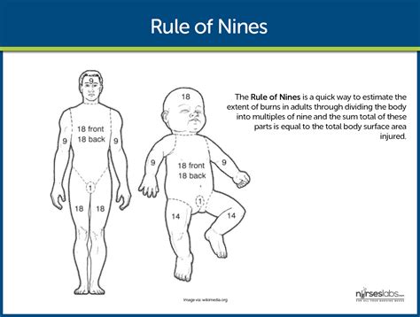 Explain The Rule Of Nines