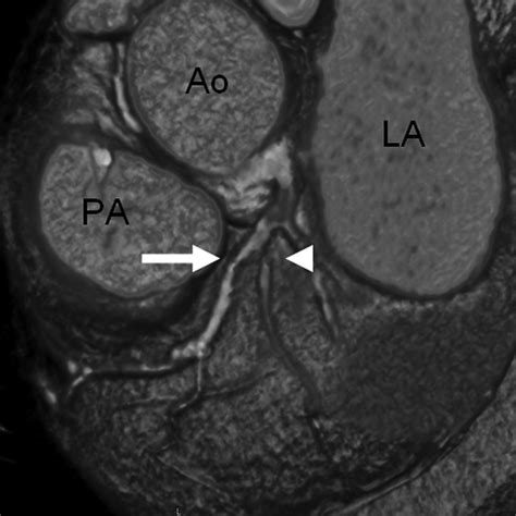 Clinical Value Of Mdct In The Diagnosis Of Coronary Artery Disease In