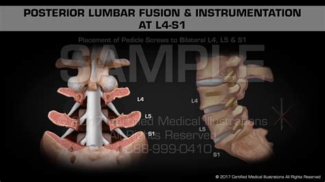 Posterior Lumbar Fusion And Instrumentation At L4 S1 Youtube