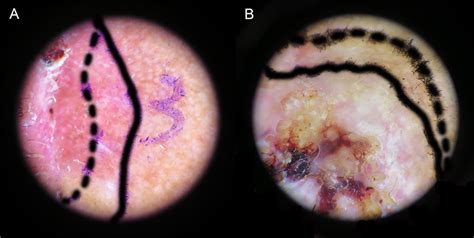 Delineation Of Tumor Boundaries By Naked Eye Dashed Line And