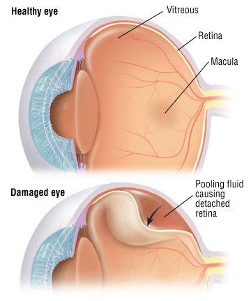 Detached Retina Guide Causes Symptoms And Treatment Options