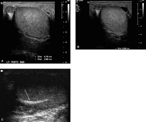 Normal Epididymis Ultrasound