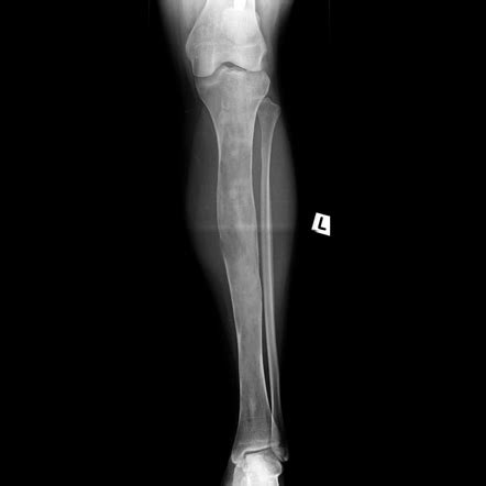 Fibrous Dysplasia Polyostotic Radiology Case Radiopaedia Org