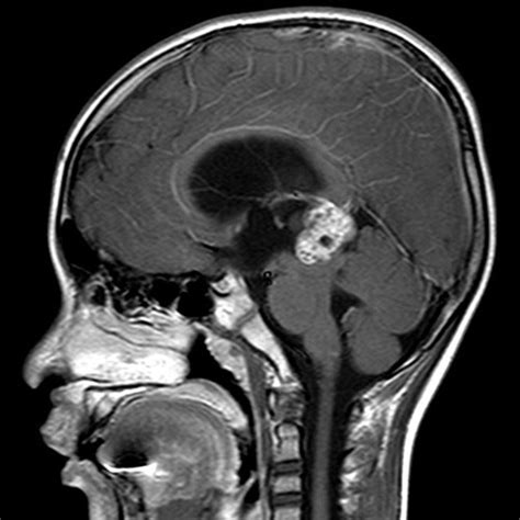 Cyst of the pineal gland: causes, symptoms, treatment - All information about cysts