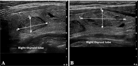 Ultrasound Of Right Thyroid Lobe With A Well Defined Solid Hypoechoic Download Scientific