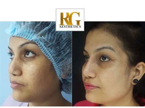 Rhinoplasty Before After Results Dr Rajat Gupta