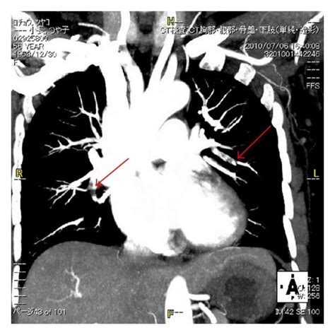 A Contrast Enhanced Computed Tomography Revealed The Presence Of