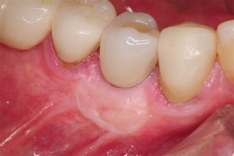 Treatment Of Gum Recession Around Dental Implants With Soft Tissue