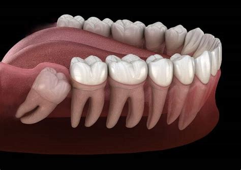 Estrarre I Denti Del Giudizio In Anestesia Totale Gallottini