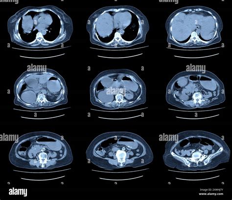 Ct Scan Abdomen Hi Res Stock Photography And Images Alamy