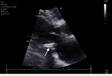 Transthoracic Echocardiogram Parasternal Long Axis View Demonstrating