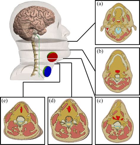 High Resolution Multi Scale Computational Model For Non Invasive