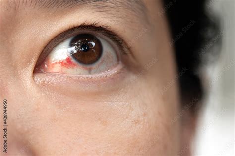 Broken Blood Vessels Subconjunctival Hemorrhage Broken Capillaries In