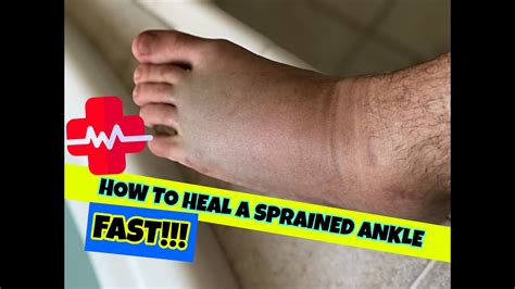 Heal A Sprained Ankle Fast Skate School 86 Youtube