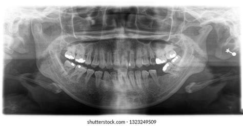 X Ray Human Mouth Teeth Bones Stock Photo 1323249509 | Shutterstock