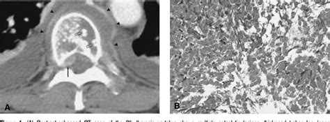 Figure 1 From A Case Of Nonsecretory Multiple Myeloma With Atypical