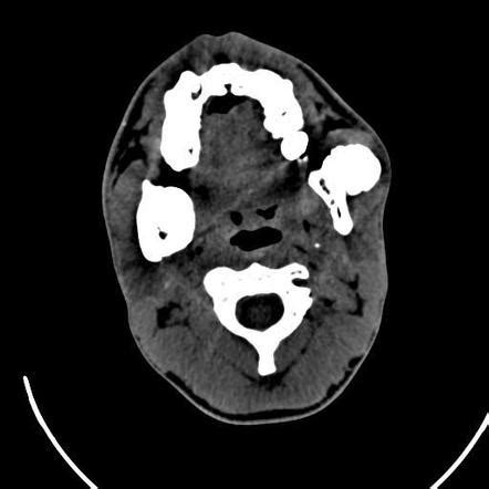 Gardner Syndrome Image Radiopaedia Org