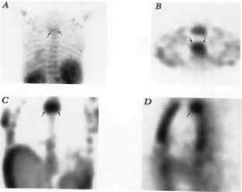 Tc M Mibi Spect And Spot Images Of Thorax A Focally Increased Uptake