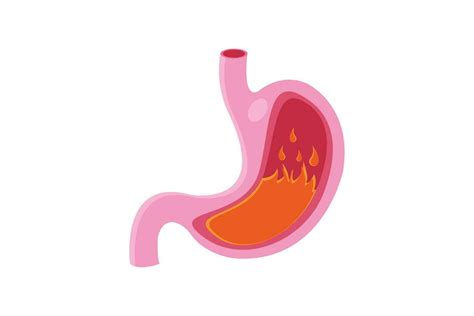 Medical Illustration Of Pyrosis Stomach Isolated Fire Disorder Inside