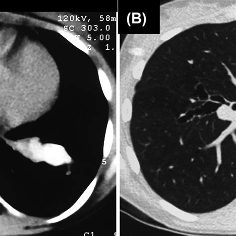 High Resolution Computed Tomography Lung Window Showing Mosaic