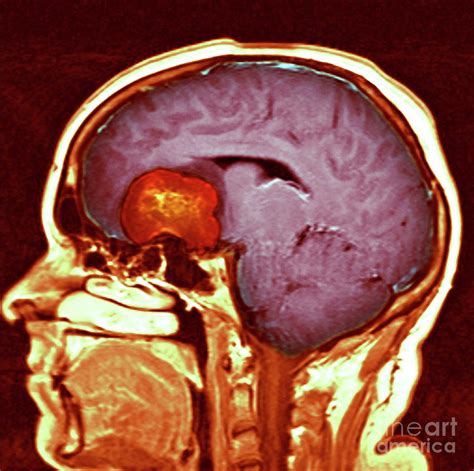 Brain Tumour Photograph By Simon Fraser Newcastle Hospitals Nhs Trust