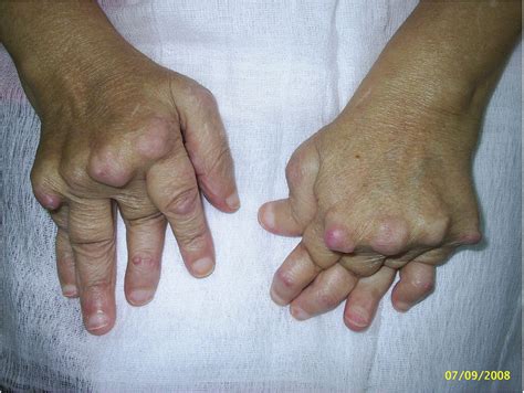 Laryngeal Manifestations Of Rheumatoid Arthritis Intechopen