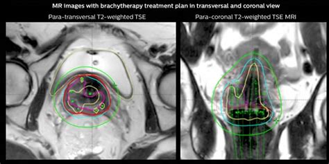 Mri In Rt A New Vision For Radiotherapy Philips