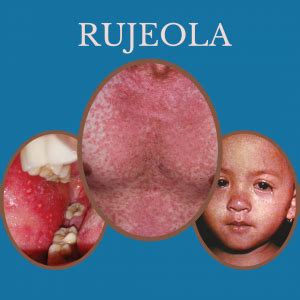 Rujeola - e-medicina.md