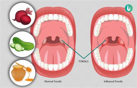 टॉन्सिल टॉन्सिलाइटिस के लक्षण कारण इलाज दवा उपचार और परहेज Tonsillitis Symptoms Causes