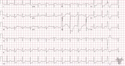 Global Subendocardial Ischemia Ecg Stampede