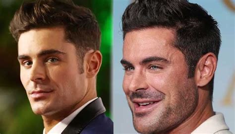 Plastic Surgeon Finally Reveals What S Happened To Zac Efron S Face