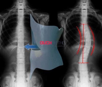 Scoliosis Braces In depth