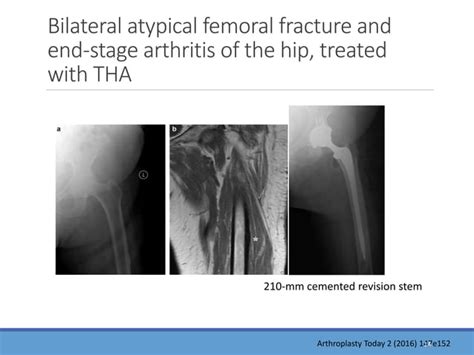 Management Of Atypical Tha Periprosthetic Fracture Ppt