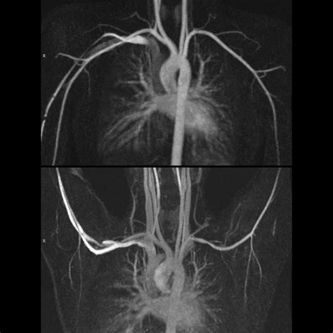 Pediatric Thoracic Outlet Syndrome Pediatric Radiology Reference