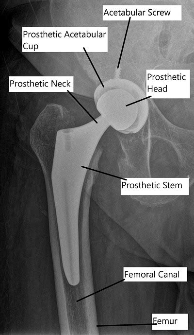 Total Hip Arthroplasty