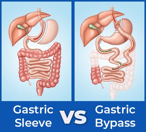 sleeve gastrectomy  gastric bypass
