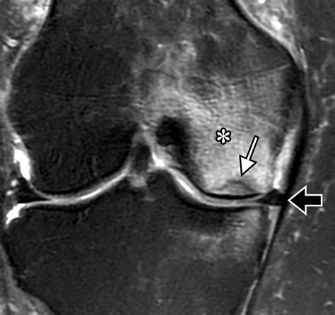 Osteochondral Lesions Of The Knee Differentiating The Most Common