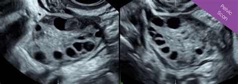 Infertility Scan Ultrasound Women Scans Ireland