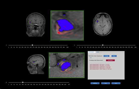 Wall Enhancement Segmentation For Intracranial Aneurysm