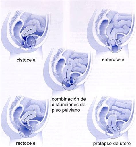 El Prolapso Cuando Las Paredes Se Nos Caen Pelvium Fisioterapia Del