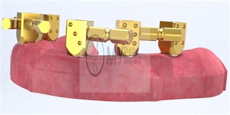 Dental Abutment Level Scanbody For Edentulous Case To Get Accurate