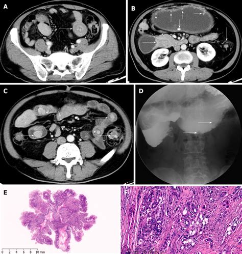 Preoperative Imaging And Clinical Pathological Features Of Case 3 A